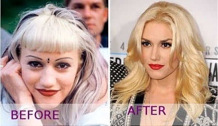 A before and after picture of Gwen Stefani showing her changing nose.